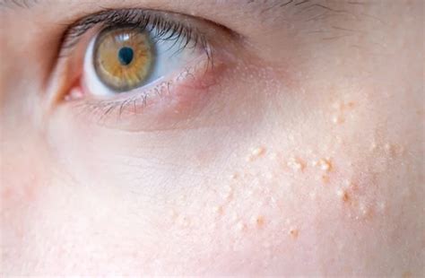 Milialar Skin Disease Causes Symptoms Treatment And Precautions