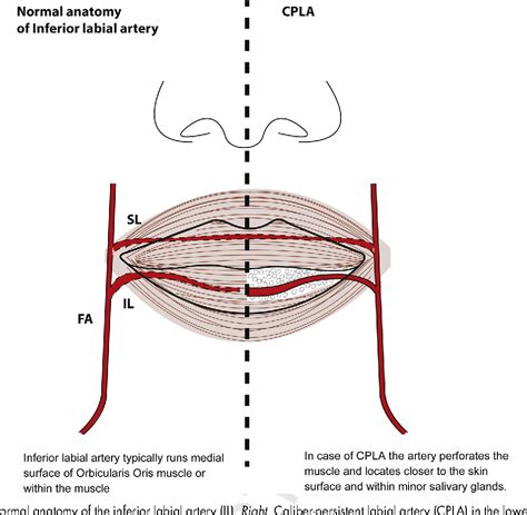 Figure 2 From Caliber Persistent Labial Artery A Rarely Recognized