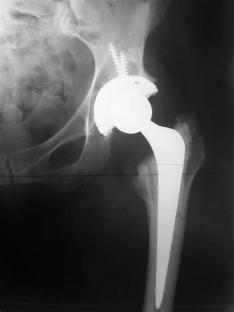 Total Hip Replacement Regain Ortho Best Orthopedic Hospital In Hyderabad