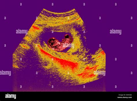 Fetal Ultrasound Scans Hi Res Stock Photography And Images Alamy
