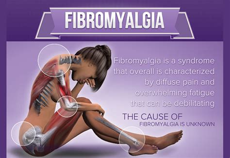 Fibromyalgia Infographic Visualistan