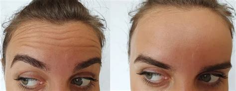 Woman Forehead Wrinkles Before And After Treatment Stock Image