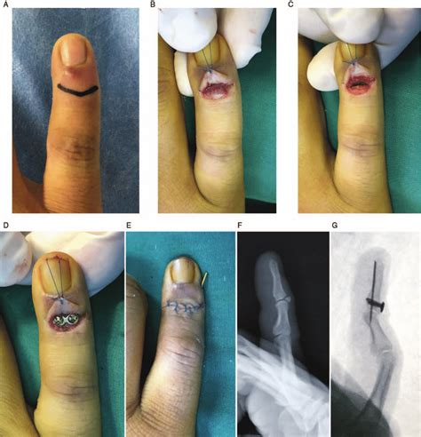 Treatment Of A Mallet Fracture That Involved The Little Finger With A