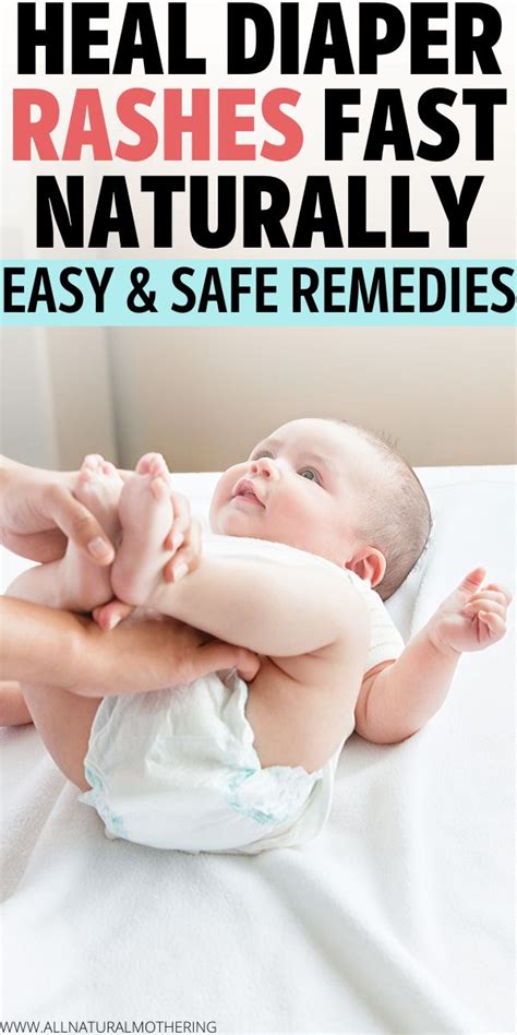 8 Natural Remedies To Treat Diaper Rashes At Home Baby Remedies Baby
