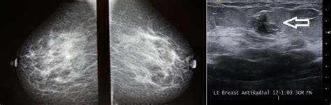 Breast Density — Metritrack