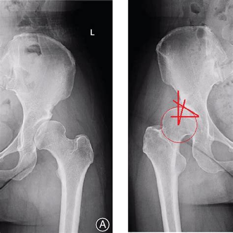 anteroposterior ap pelvic radiograph is shown a pubic symphysis to download scientific