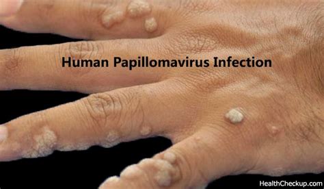 Human Papillomavirus Infection The Most Common Sexually Transmitted