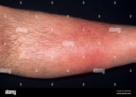 Recurrent Cellulitis On A 51 Year Old Mans Lower Leg Cellulitis Is A