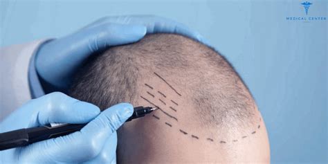 Hair Transplant Surgery Before And After Medical Center Turkey