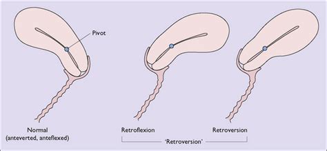 Retroflexed Vs Retroverted Uterus