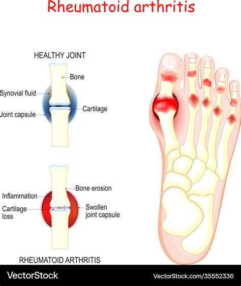 Rheumatoid Arthritis In Joints Humans Foot Vector Image