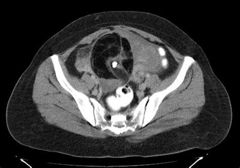 Radiodiagnosis Imaging Is Amazing Interesting Cases Ovarian Dermoid CT