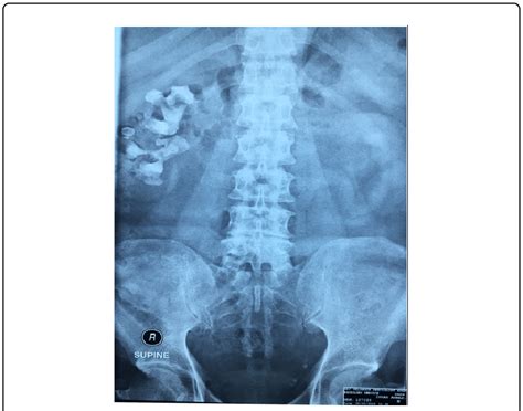 Kub X Ray Showing Large Right Renal Staghorn Calculi Download