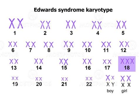 Edwards Syndrome Karyotype Fra Zuzana Mostphotos