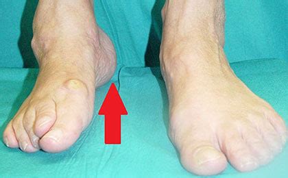 Intervento Protesi Di Caviglia Su Misura Dott Andrea Scala