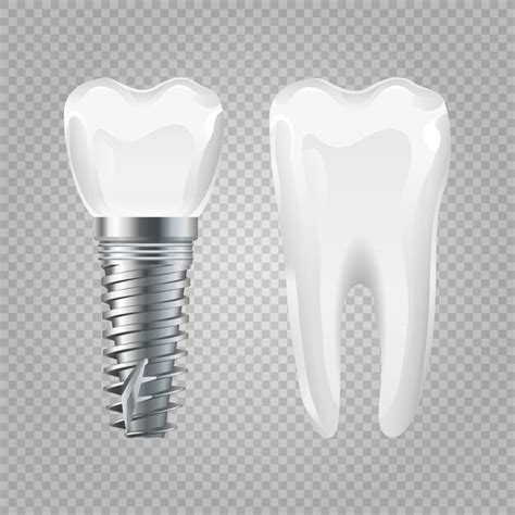Implante Dental Implante Y Diente Sano Realista Elementos De Cirugia