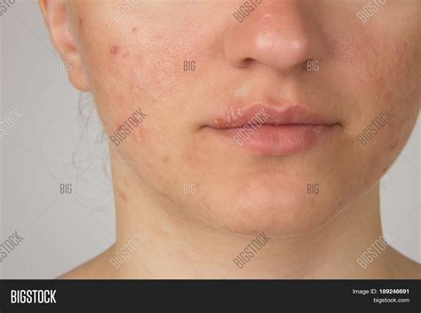 Herpes Sore Pus On Image And Photo Free Trial Bigstock