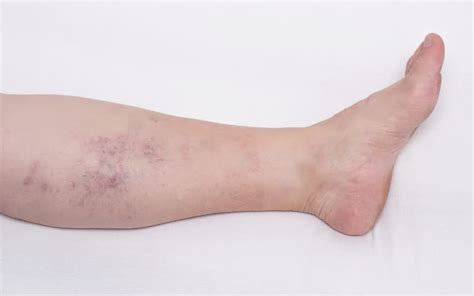Phlebitis Vs Cellulitis Understanding The Differences Vein Solutions