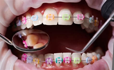 ทำไมต้องเปลี่ยนยางจัดฟันทุกเดือน พร้อมเคล็ดลับเลือกสียางจัดฟัน Dental
