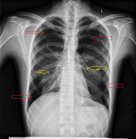 Pneumothorax Chest X Ray Chest X Ray At Presentation Pneumothorax