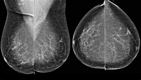 Comprehensive Review Of Breast Imaging Ubicaciondepersonas Cdmx Gob Mx