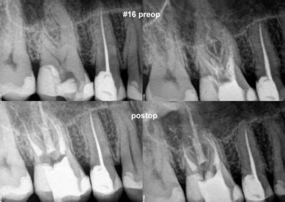 Leczenie Kana Owe Pod Mikroskopem Warszawa Moje Prace Endodontyczne