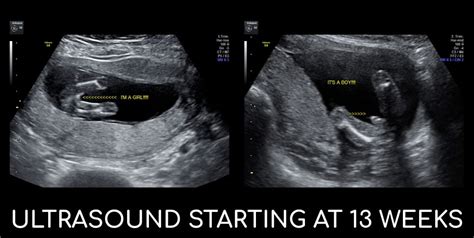 Early Gender Ultrasound Pricing Inside View 3d4d Ultrasound