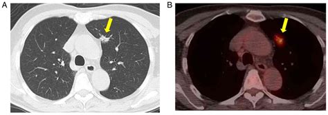 Solitary Lung Metastasis From Primary Prostate Cancer With Normal Prostate Specific Antigen