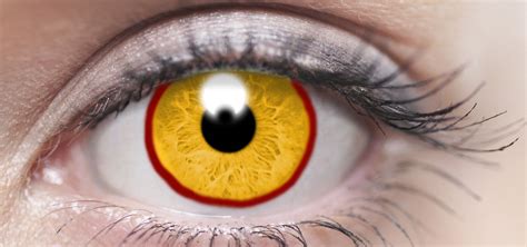 Red Ring Around Iris Eyelids Eye Socket In Babies And More American
