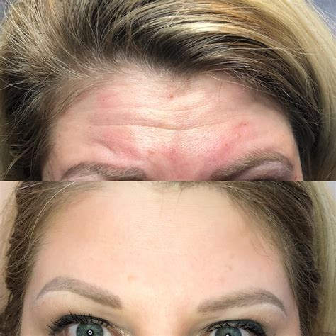 Botox And Fillers Before And After Gallery Eon Medical Spa