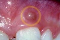 What does a gum abscess look like? Gum Boil | Med Health Daily