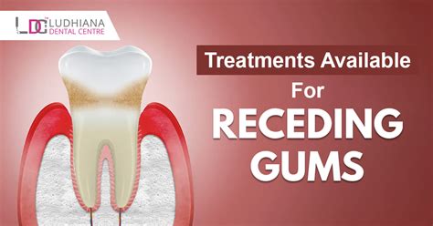 Treatments Available For Receding Gums