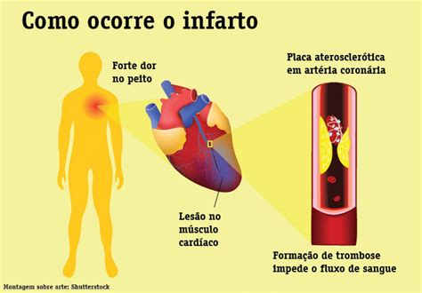 Quais Os Sintomas Do Ataque Cardíaco Ou Infarto