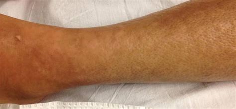 Dermatoses Systemic As Related To Eosinophilic Fasciitis Pictures