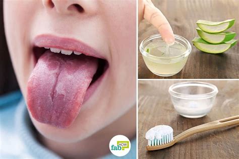 7 Home Remedies To Get Rid Of Burning Mouth Syndrome Burning Mouth