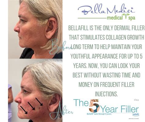 Bellafill Kit Before And After Injectables Fillers Collagen Growth