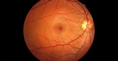 Retinopathy And Retinal Detachment Best Eye Diseases Doctors In Iran