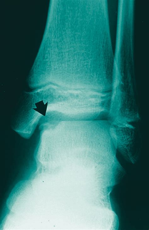 How To Address Osteochondral Lesions Podiatry Today