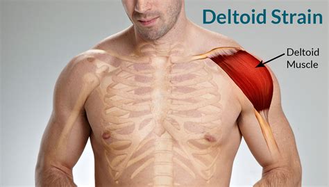 Deltoid Strain Treatment Causes Symptoms Classification