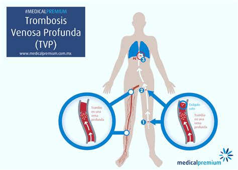 Trombosis Venosa Profunda Y Embolia Pulmonar Medical Premium