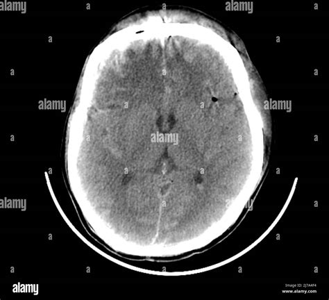 Traumatic Brain Injuries Ct Scan Stock Photo Alamy