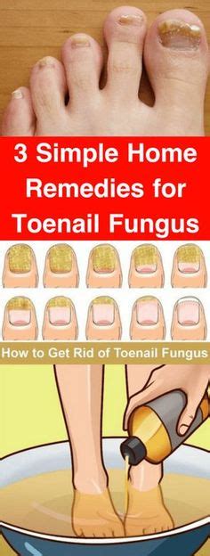 8 Toe Fungus Ideas Toenail Fungus Remedies Toe Fungus Toenail Fungus