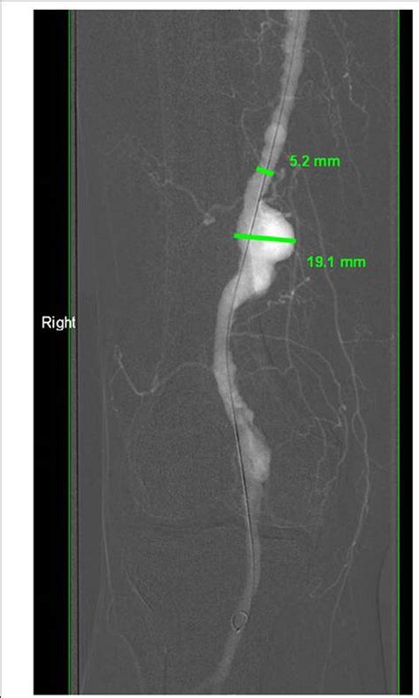 Evaluation Diagnosis And Management Of Popliteal Artery Aneurysms A