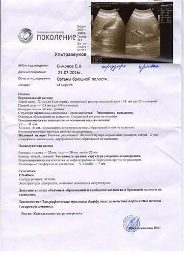 Диет рецепт при гепатозе Жировой гепатоз - Вопрос гастроэнтерологу - 03 Онлайн Жировой гепатоз - Вопрос гастроэнтерологу - 03 Онлайн Диет рецепт при гепатозе
