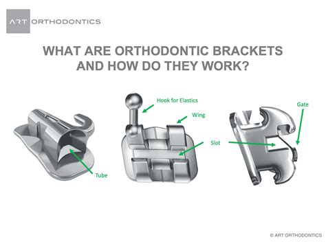 Orthodontic Brackets Braces How Do They Work Art Orthodontics Davie