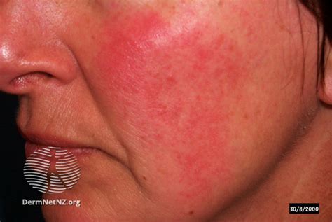 rosacea dermnet nz acne red face nc commons
