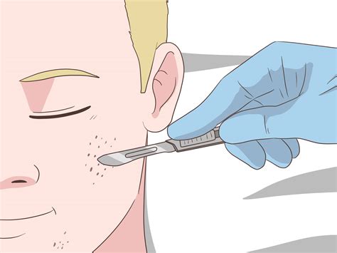 4 Ways to Get Rid of Acne Cysts Fast - wikiHow
