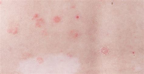 What Is Guttate Psoriasis