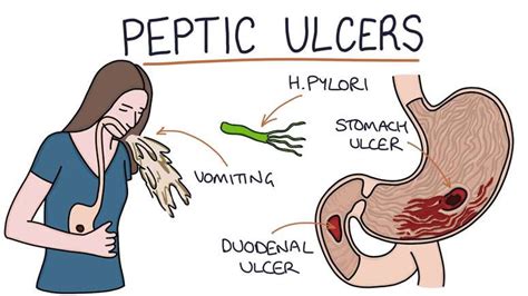 Signs Of A Bleeding Stomach Ulcer Ulcertalk Hot Sex Picture