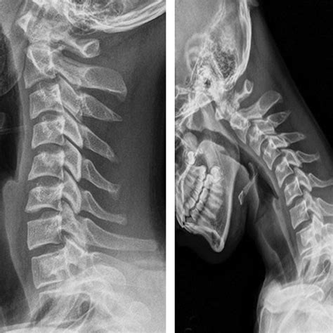 Radiographs Of The Cervical Spine In Anteroposterior A And Lateral